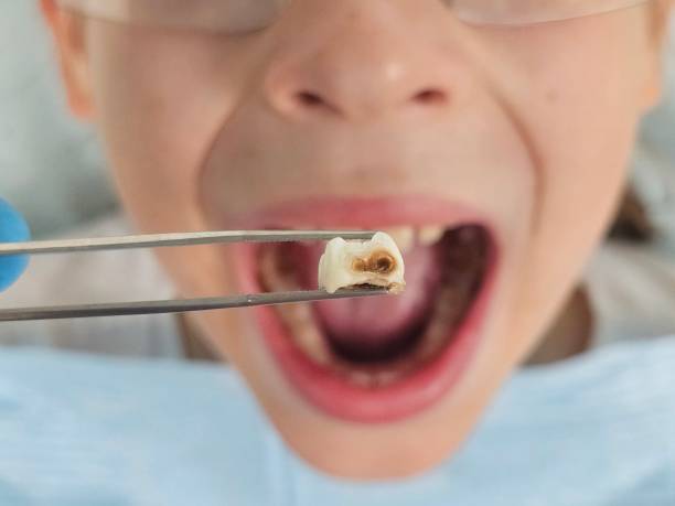 Best Emergency Root Canal Therapy in Upton, WY